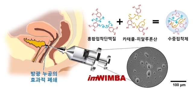 방광 누공 수중접착제