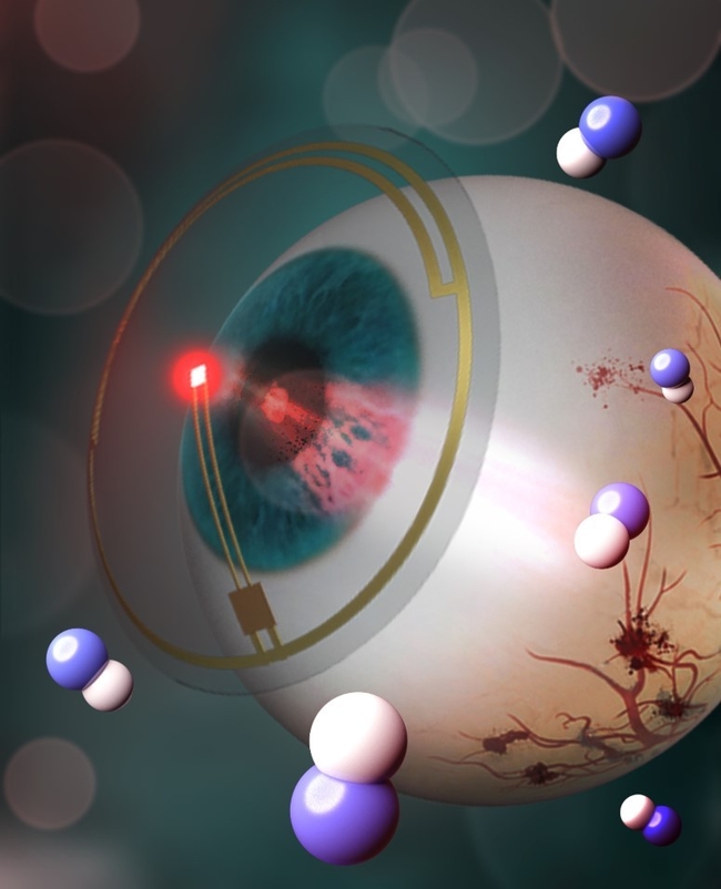 LED가 장착된 무선구동 스마트 콘택트렌즈를 이용한 당뇨성 망막병증 예방·조기 치료 시스템에 대한 모식도