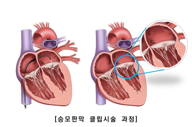 서울아산병원, 승모판막 클립시술 국내 첫 50례(사진=서울아산병원 제공)