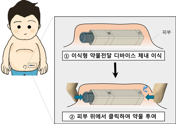 단 한 번의 이식 후 피부 위에서 손가락으로 ‘클릭’하면 정교한 양의 약물이 방출되는 디바이스(사진=서울대병원 제공)