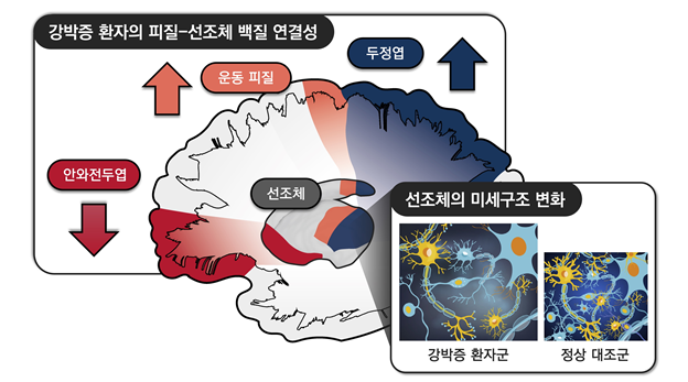 강박증 환자에서 관찰한 대뇌 피질-선조체 회로의 변화. 안와전두엽과의 연결성은 감소한 반면, 운동 피질과 두정엽과의 연결성은 증가해 있어, 대뇌피질-선조체 회로의 균형이 깨져있는 것으로 나타났다. 또한 연구팀은 강박증 환자에서 선조체 영역의 미세구조도 손상되었다는 것을 확인했다.(이미지=서울대병원 제공)