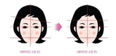헤어라인교정으로 안면비대칭 교정까지